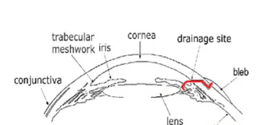 Glaucoma Surgery