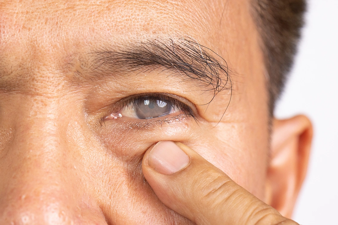 An elderly man with a cataract in his eye
